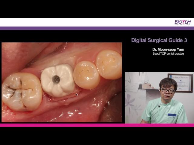 디지털 서지컬 가이드 3강 (Digital Surgical Guide 3) -바이오템 임플란트 BIOTEM IMPLANT