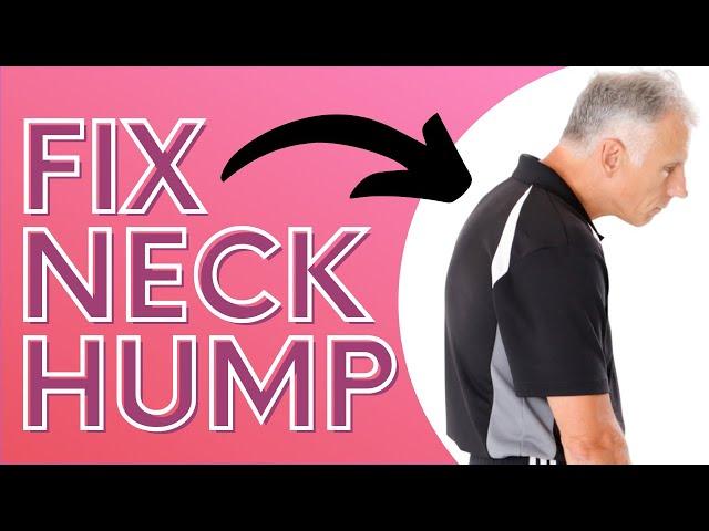 How You Can Get Rid of Neck Hump With a SOCK. Dowager's Hump.