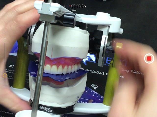 SETTING UPPER DENTURE TEETH