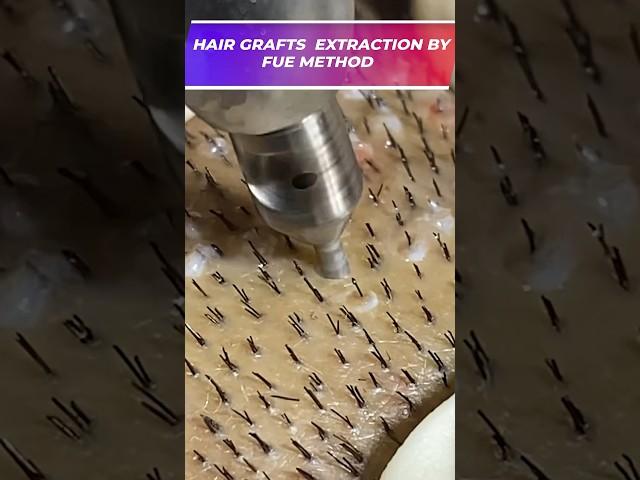 Hair Grafts Extraction By FUE Method | Hair Transplant By FUE Method