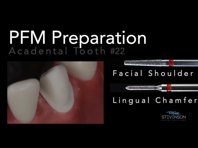 PFM Preparation on Mandibular Canine - Acadental Tooth #22