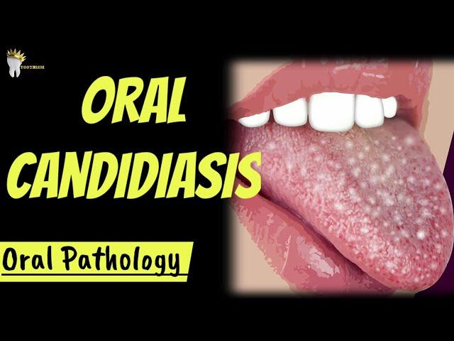 ORAL PATHOLOGY | ORAL CANDIDIASIS