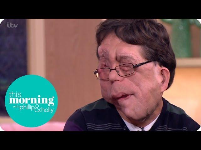 Adam Pearson Talks About Judging People By Their Looks | This Morning