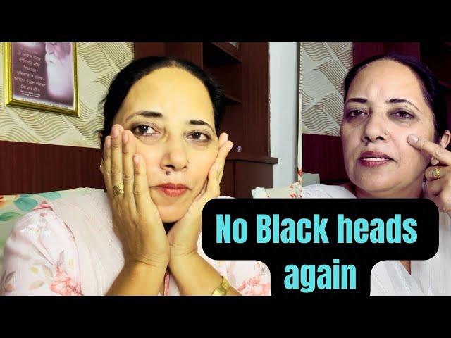 ਬਲੈਕਹੈਡ,ਵਾਈਟਹੈਡ ਜੜ ਤੋਂ ਖਤਮ,Remove blackheads and whiteheads naturally