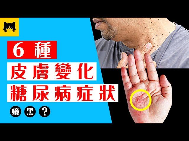 糖尿病症狀：6種出現在皮膚的糖尿病症狀 （皮膚癢 變黑 感染。。）