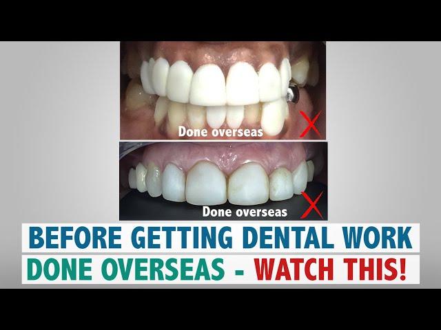 Before Getting Dental Work Done Overseas – Watch This