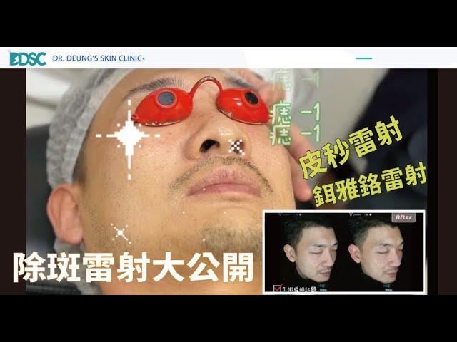 【除斑療程spot removal】大公開 | 曬斑Solar lentigo、老人斑Age spots 、痣naevus 除斑雷射大不同 | 治療方法對才有效 | 皮膚專科醫師張英睿