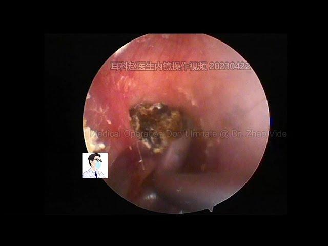 A cholesteatoma Looks like a blackhead in ear,20230422