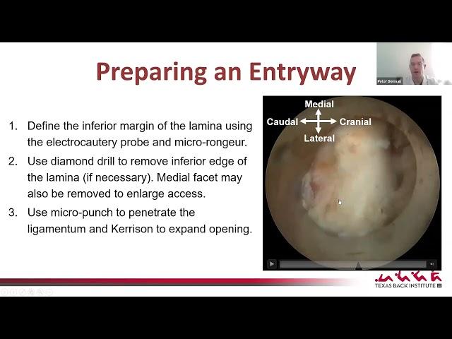 Introduction to Endoscopic Spine Surgery : Peter Derman, MD, MBA