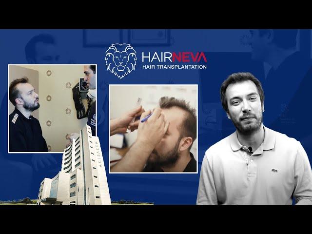 Mehmet's True Hair Transplantation Story From Beginning to End Part