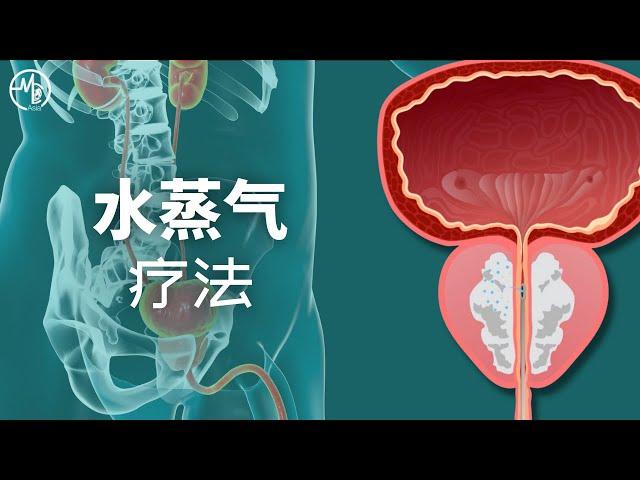 水蒸气疗法 | 良性前列腺增生 (BPH)