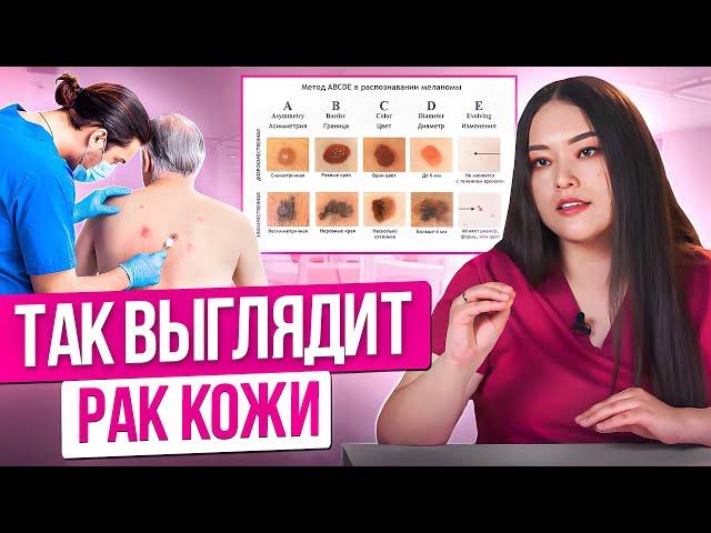 ОПАСНЫЕ РОДИНКИ: как распознать родинку вызывающую РАК? Меланома: как распознать опасные родинки?