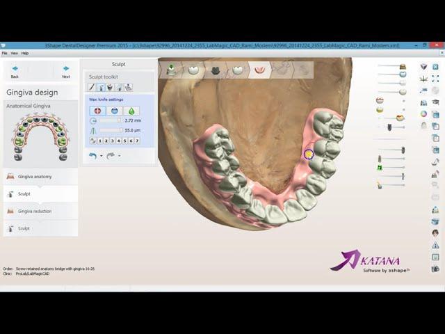 How to design an artificial gingiva for hybrid implants bridge in 3Shape