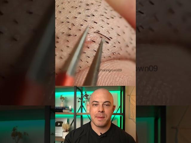 Derm reacts to stubborn ingrown hair removal! #dermreacts #doctorreacts #ingrownhair