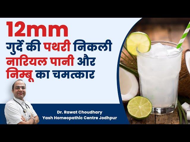 12mm Kidney Stone Treatment with Home Remedy | की पथरी निकाली घरेलु नुस्खे से | Kidney Stone remedy