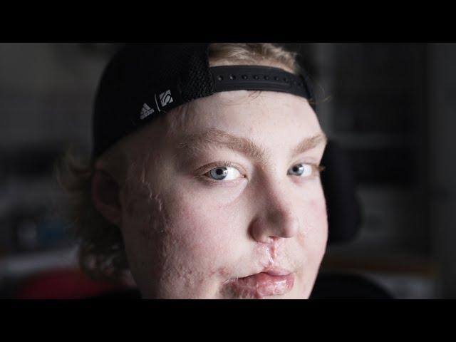 Viktor, 17, drabbades av sepsis