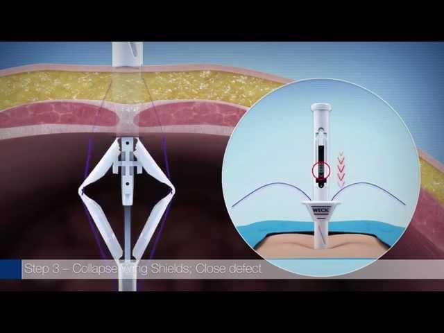 Weck® EFx Shield™ Fascial Closure System Animation - Teleflex