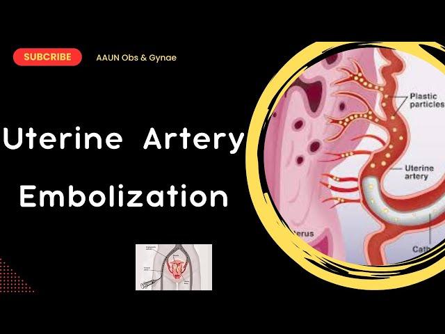 Uterine Artery Embolization: Indications, Procedure, Complications and Post Procedure Care