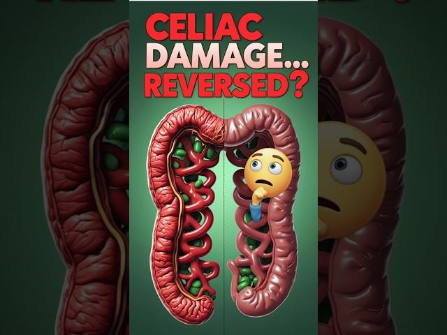 Celiac Disease: Can You Fully Recover? Find Out Now! #shorts #celiac #celiacdisease