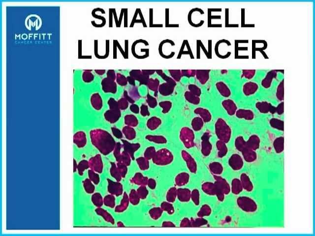 GRACEcast-076_Lung-Cancer_ASCO 2011 Highlights - SCLC, Early Stage NSCLC and Mesothelioma
