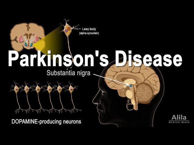 Parkinson's Disease, Animation