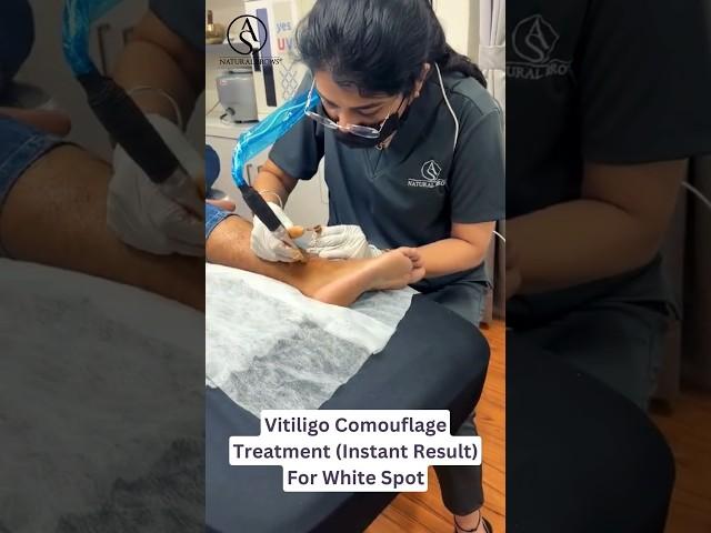 Vitiligo Treatment @pune