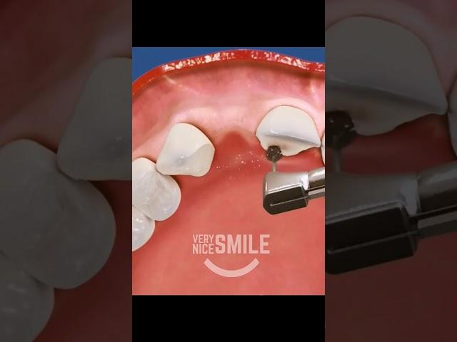 What is a Maryland dental bridge?