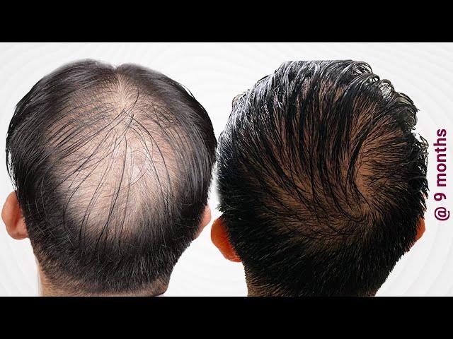 Update at 9 Months ft.Melvin Lopez – Moderator, Hair Transplant Network | Hair Transplant Result