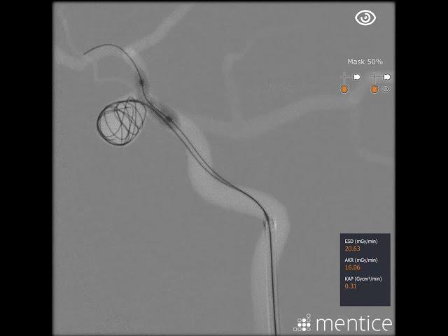 Mentice Neurovascular Brain Aneurysm Coiling Demo