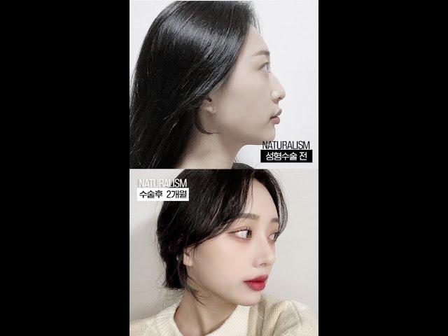 자연주의성형외과 쌍수+코성형+얼굴지방이식 성형전후영상