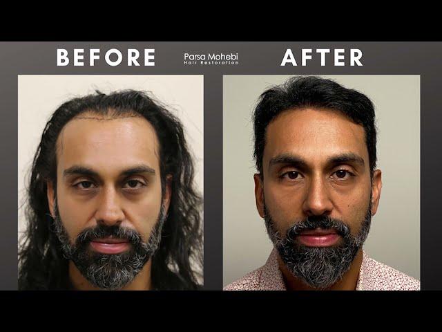 Dr. G 6 MONTH POST HAIR TRANSPLANT UPDATE