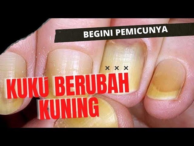 Kuku Tiba-Tiba Kuning, Tanda Penyakit Apa?