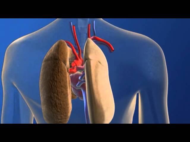 Lung Transplant