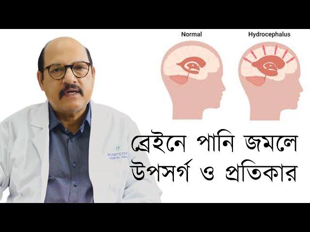 Hydrocephalus | ব্রেইনে পানি জমলে উপসর্গ ও প্রতিকার | Prof. Dr. Md. Zillur Rahman