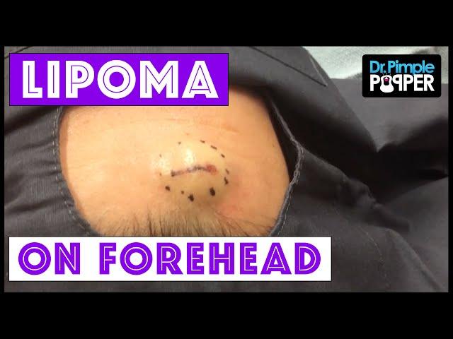 Lipoma excision on the Right Forehead: Dr Pimple Popper