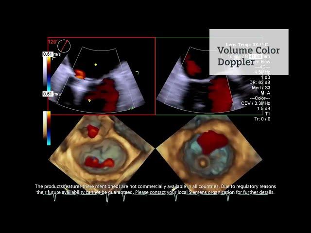 Tecnología líder en cardiología con el sistema de ultrasonido ACUSON SC2000