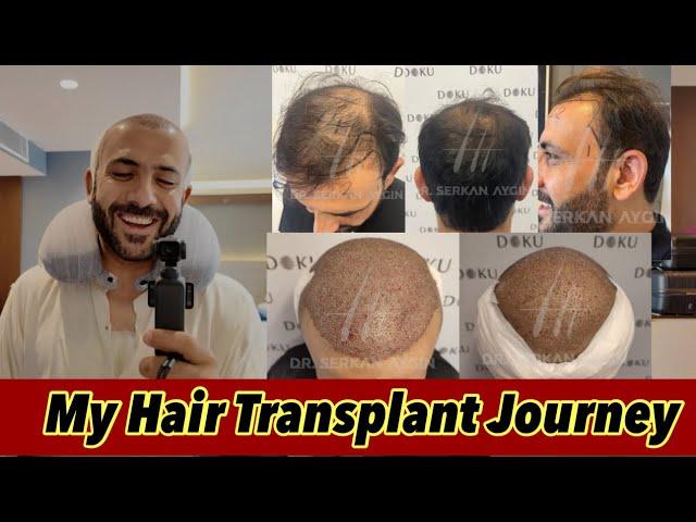 My Hair Transplant Journey | Tahir Khan Vlogs | Dr Serkin Aygün | Best Hair Transplant in Turkey |