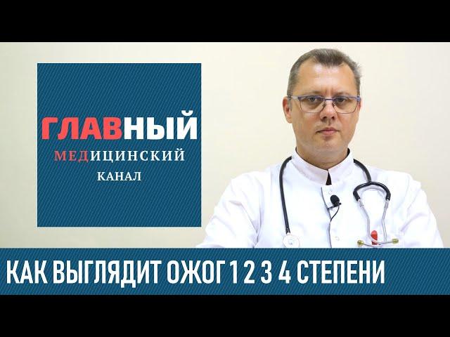 Как выглядит ОЖОГ 1, 2, 3 и 4 степени (фото 1-3). Классификация ожогов по глубине и степени тяжести