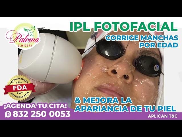 ELIMINA LAS MANCHAS CON FOTOFACIAL IPL