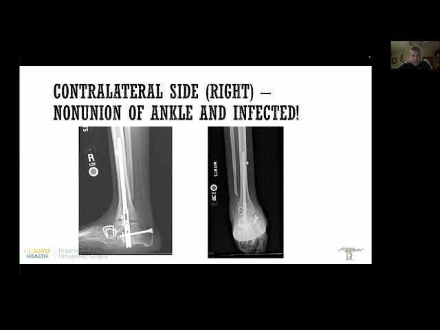 3D printed large defects for ankle salvage