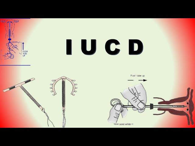 Intrauterine Contraceptive Device (IUCD) | Birth Control Device | Family Planning