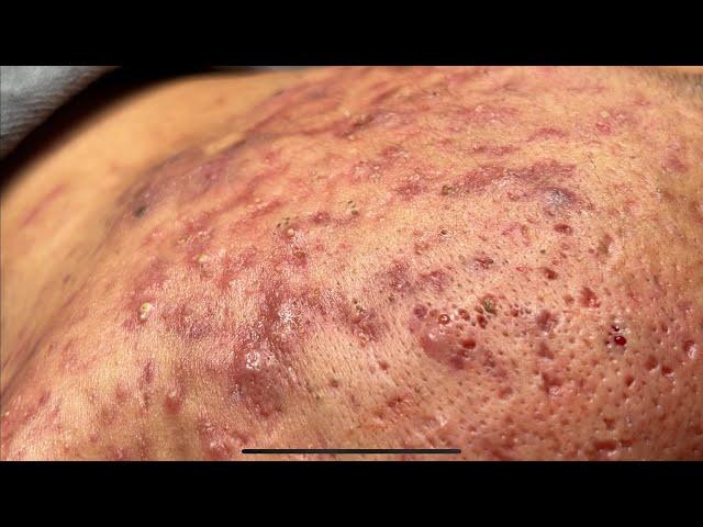 ACNE TREATMENT BO NGUYỄN |  Blackheads Removal On Boy 2024[FULL]