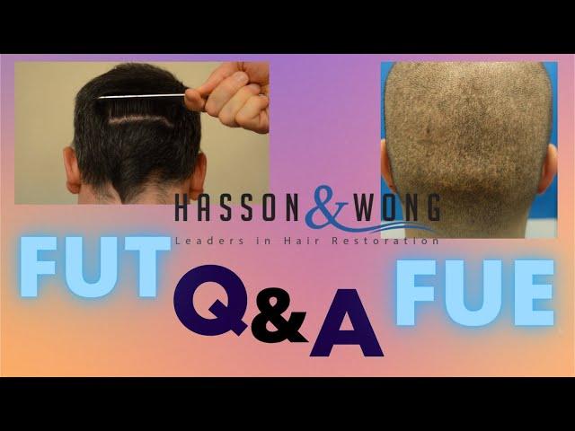 FUT or FUE Hair Transplant? *Q&A Hasson and Wong