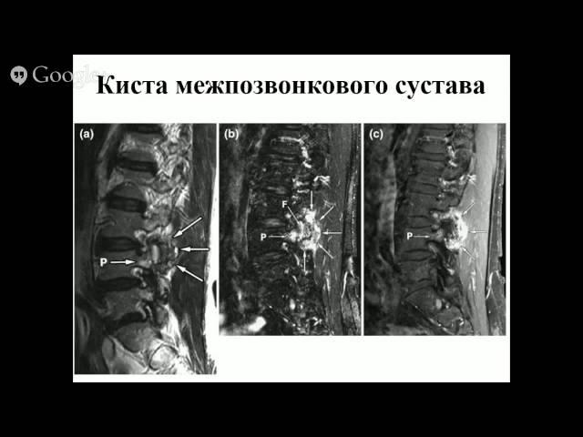 «Боль в спине - эволюция парадигмы»