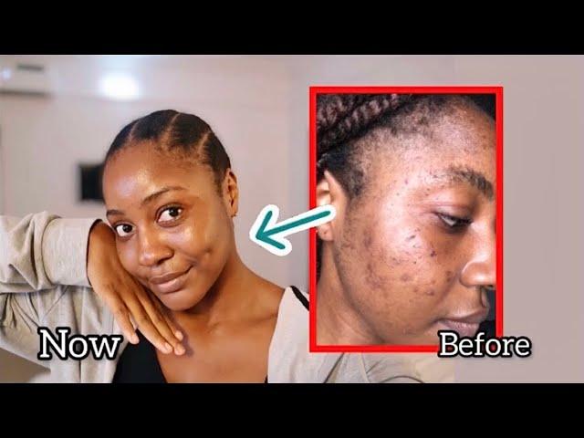 How i stopped my reoccurring acne and cleared up my skin | My skincare routine