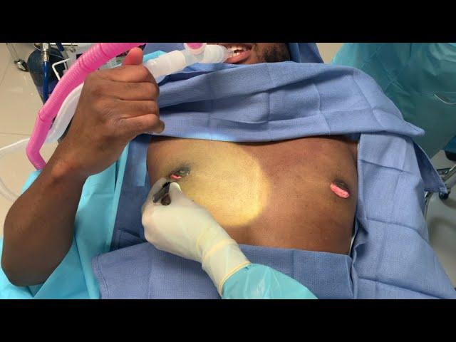 Gynecomastia Correction Under Local Anesthesia