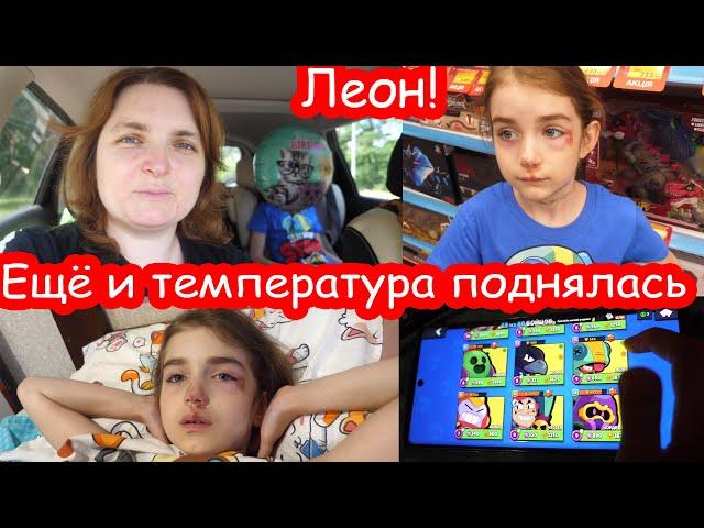 VLOG На второй день лицо сильно опухло