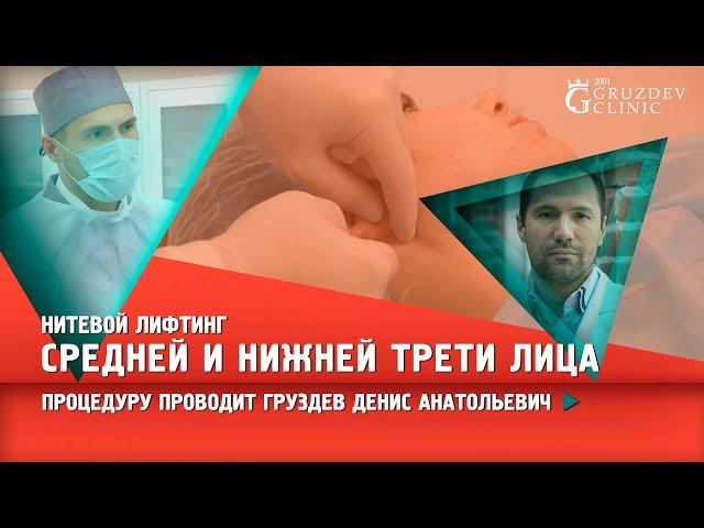 Нитевой лифтинг средней и нижней трети лица