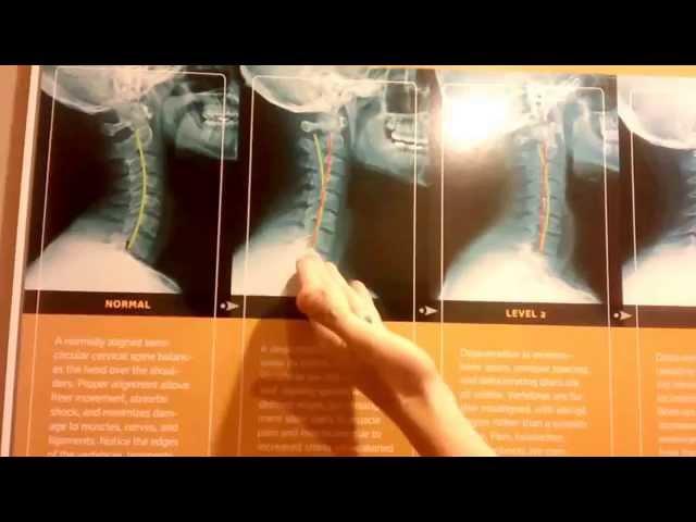 What TEXTING does to your NECK! - PART ONE - Pro Chiropractic Bozeman