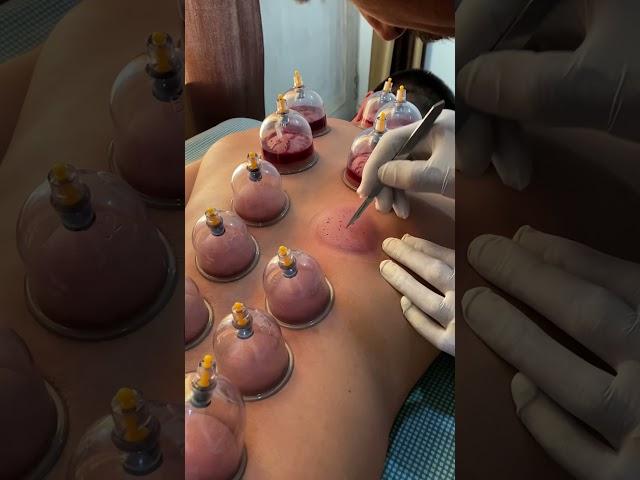 Hijama (cupping therapy)